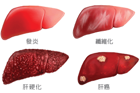 乙肝可能引起發炎、纖維化、肝硬化和肝癌