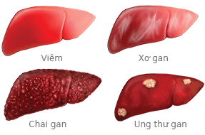 Viêm gan B có thể gây viêm, xơ gan, chai gan và ung thư gan