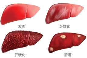 乙肝可能引起发炎、纤维化、肝硬化和肝癌