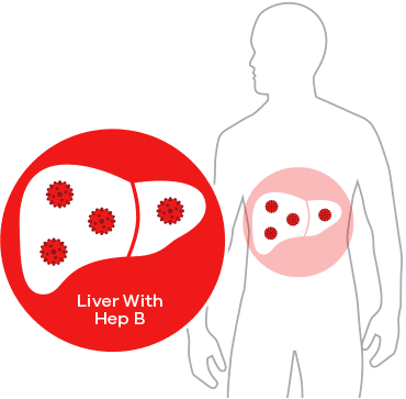 Liver With Hep B