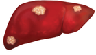 Chronic hep B is a major cause of liver cancer