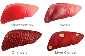 Hep B may cause inflammation, fibrosis, cirrhosis and liver cancer